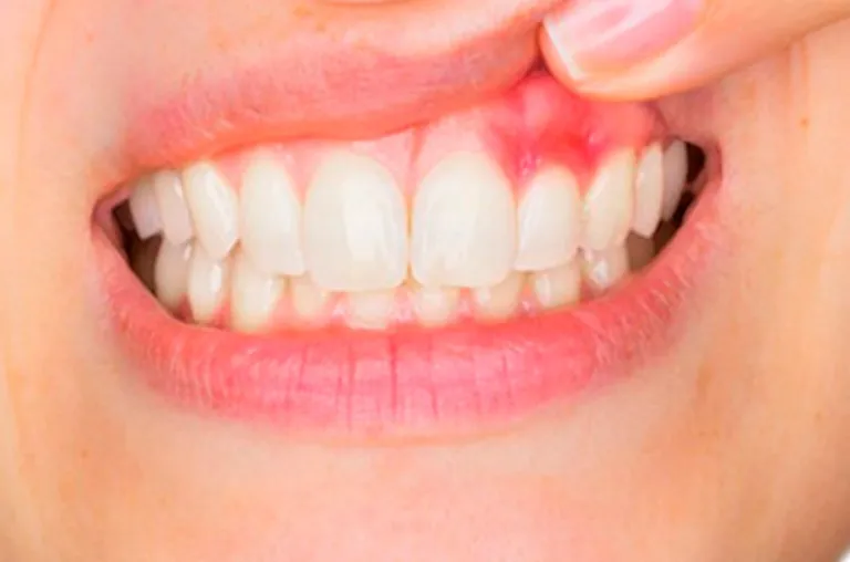 Diş Eti Tedavisi Konya - Plastik Periodontal