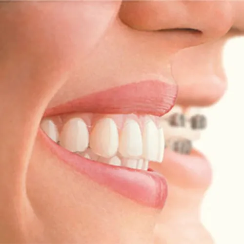 Konya Ortodonti Uzmanı - Diş Teli Tedavisi