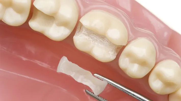 Diş Dolgusu Seçimlerinde Dikkat Etmeniz Gerekenler