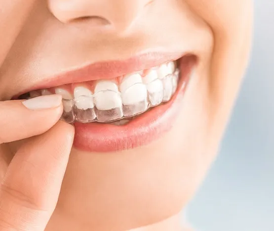 Ortodonti Tedavisi ve Ücreti