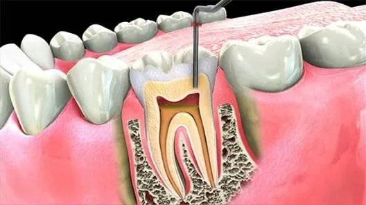 Konya Kanal Tedavisi Uzmanı - Kanal Tedavisi Endodonti